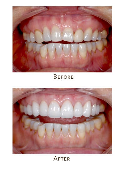 uneven gum line asymmetrical teeth shapes