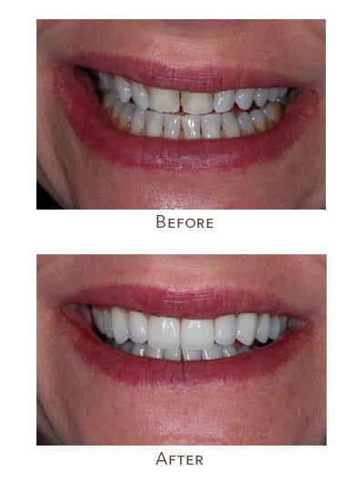 veneers in one day