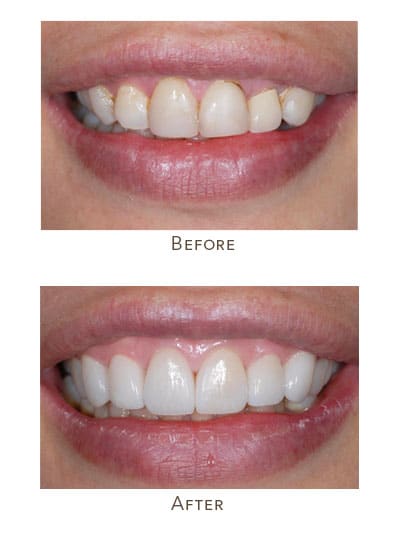 black line around teeth