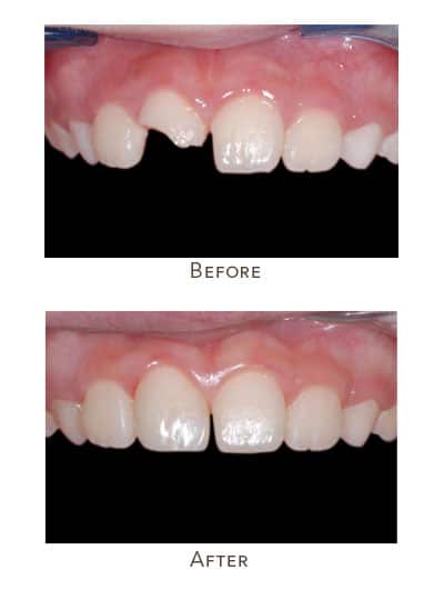 broken front incisor tooth