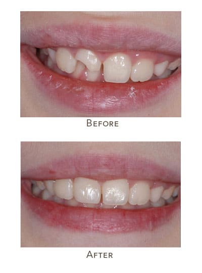child breaks permanent front tooth in half