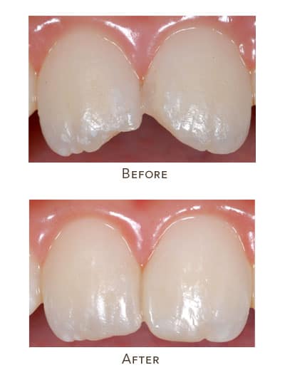 child fractured front teeth before after