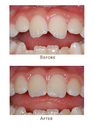 child fractured upper front teeth repair