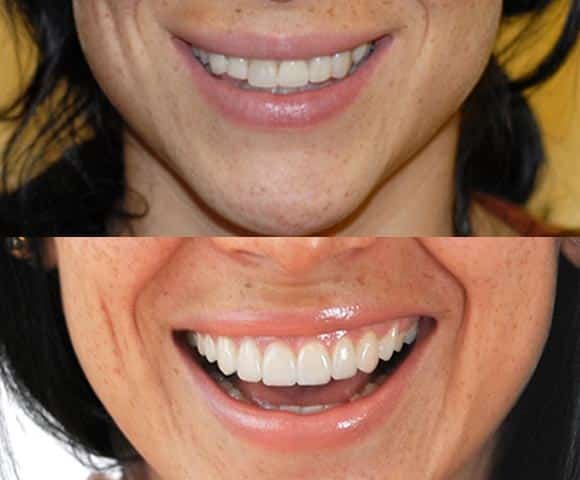 chipped front teeth 580x480