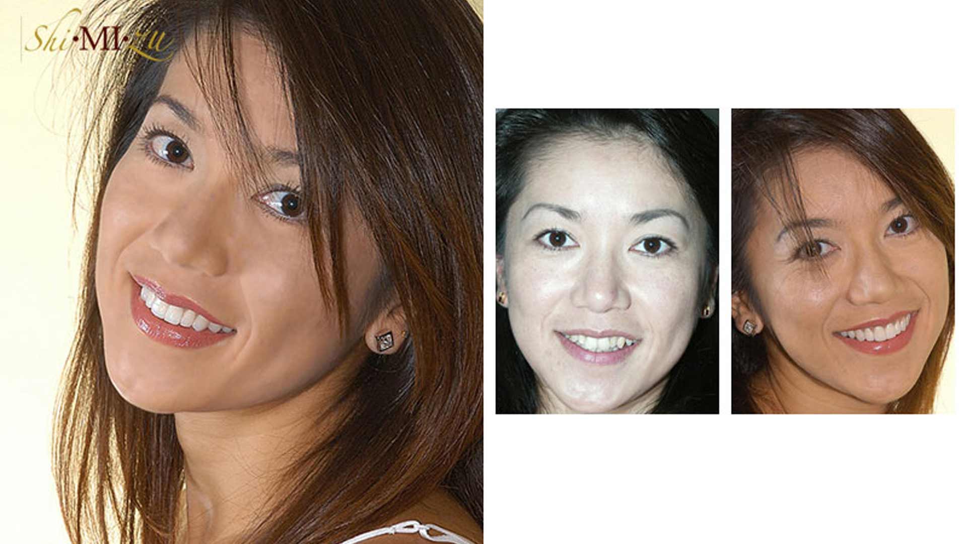 crooked overlapping teeth fix