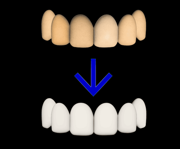 discolored teeth fix 580x480