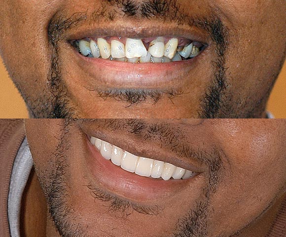 fix missing front tooth 580x480