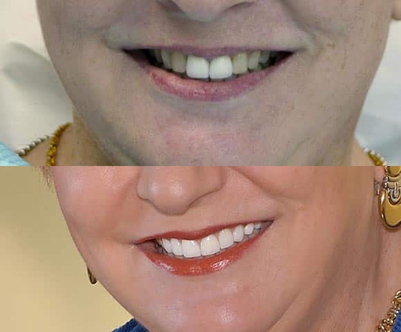 fix uneven teeth color 580x480