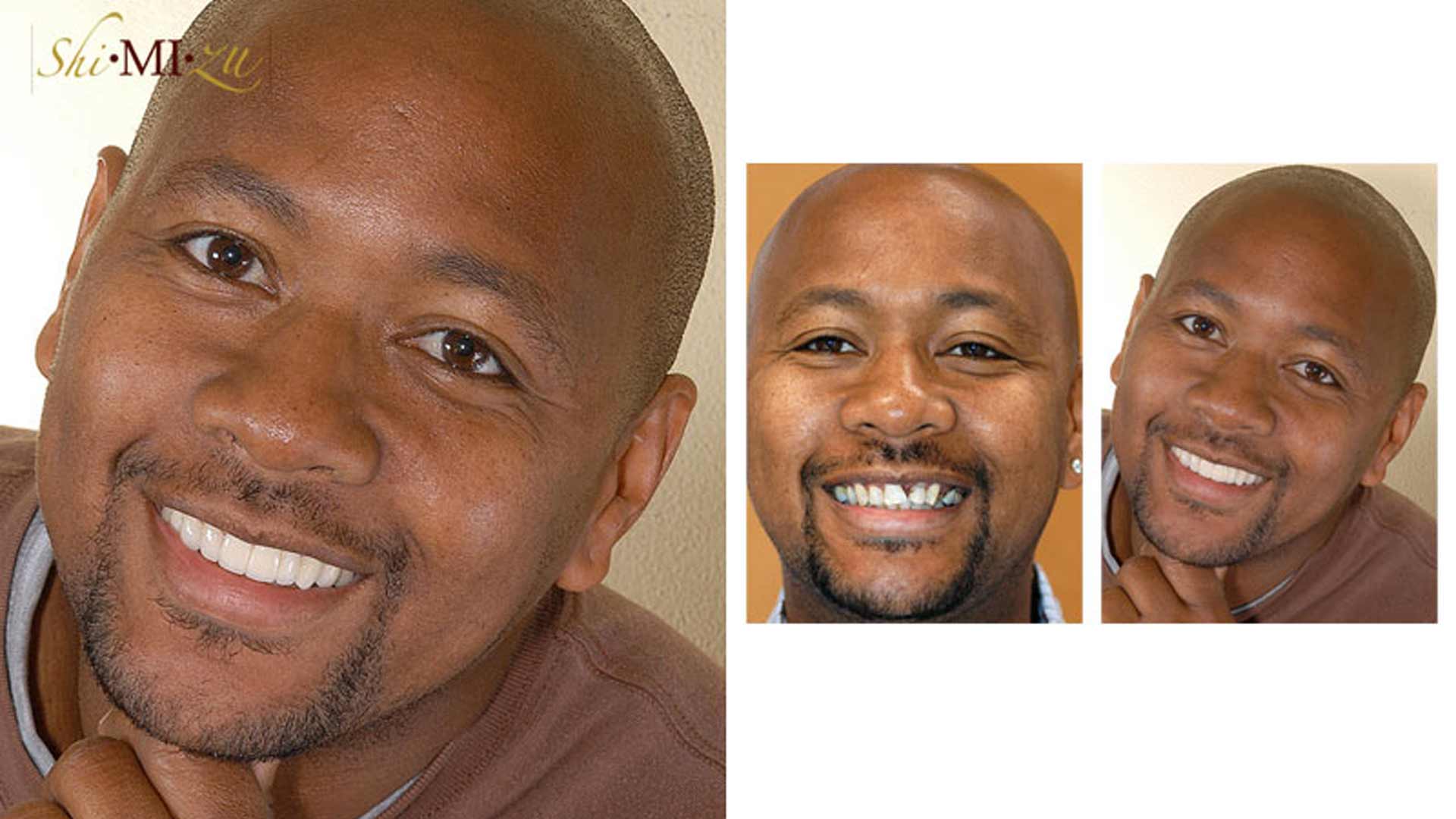 missing teeth fix c
