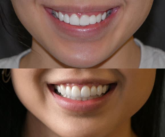 replace lumineers veneers 580x480