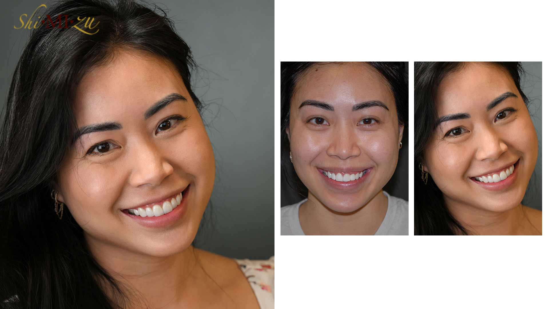 replace veneers