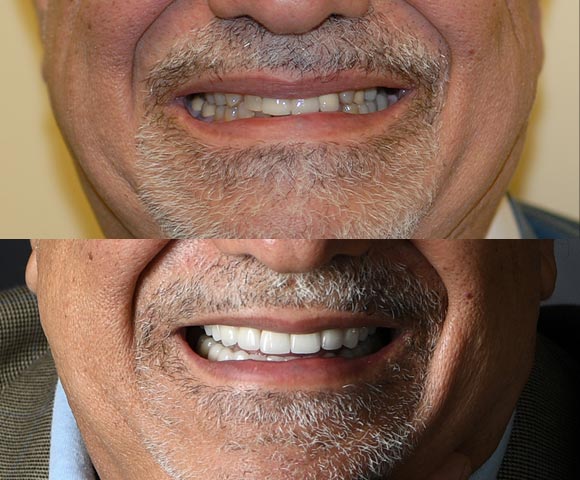 restore worn out teeth 580x480