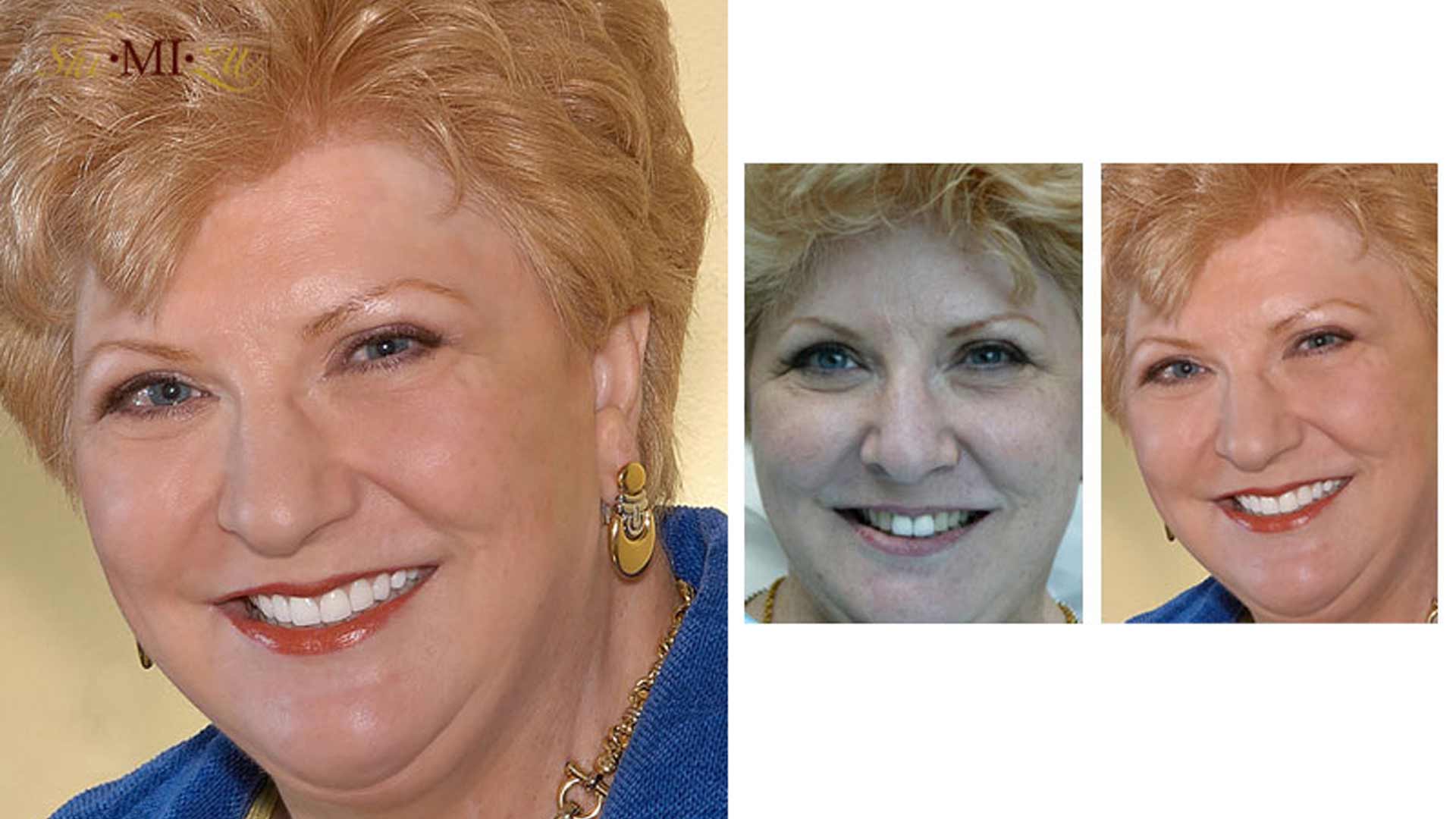 uneven teeth color fix