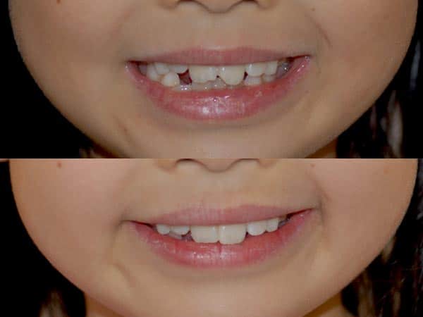 veneers for kids before after