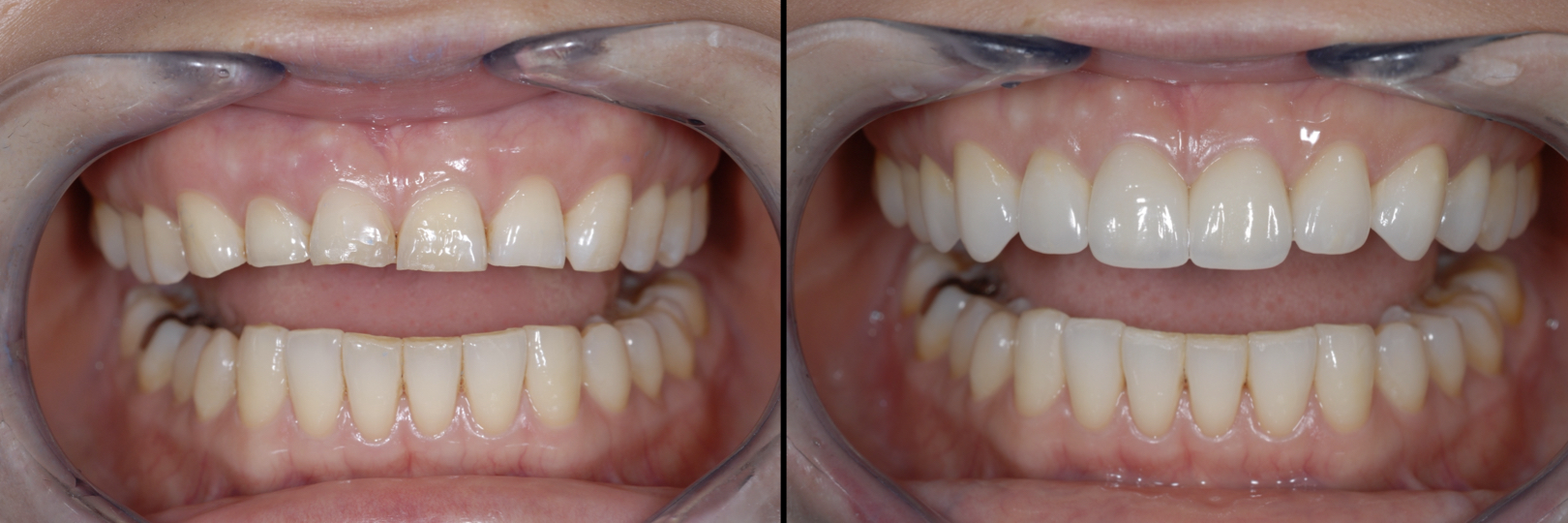 Before and After Image: Veneers - front