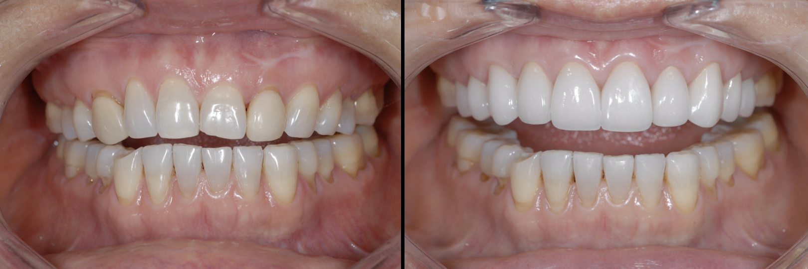 Before and After Image: Veneers -