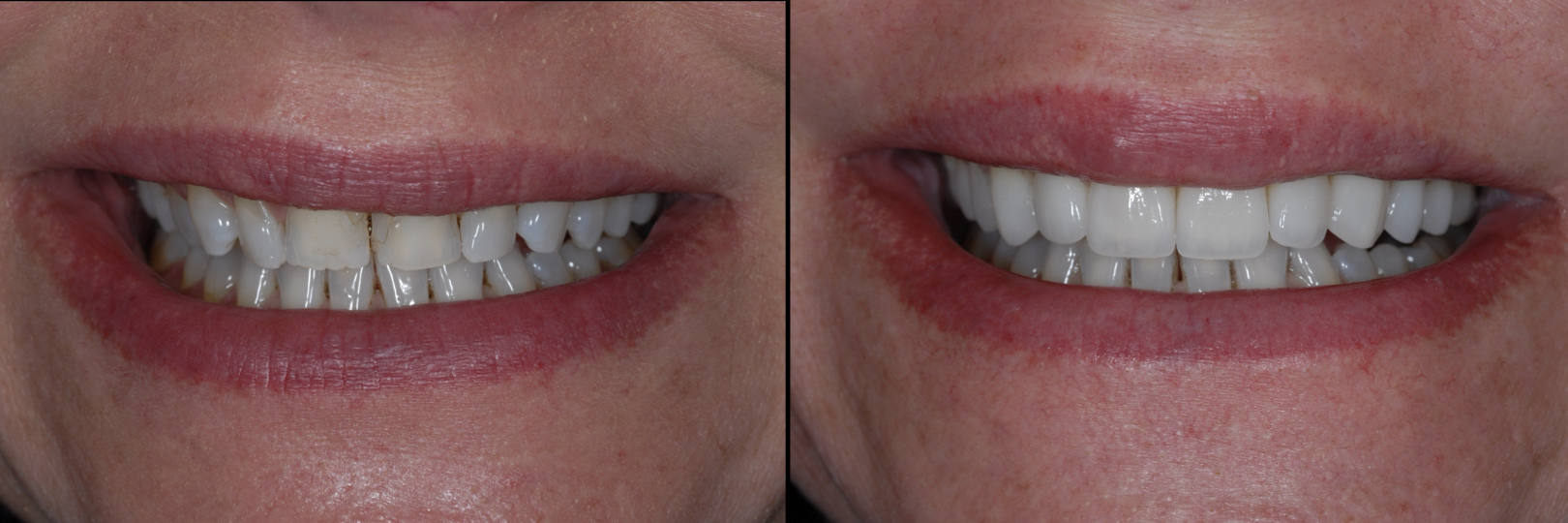 Before and After Image: Veneers