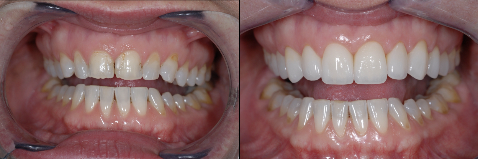 Before and After Image: Veneers - front