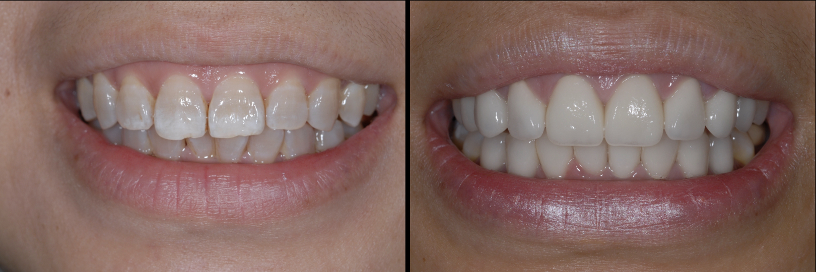 Before and After Image: Veneers - front