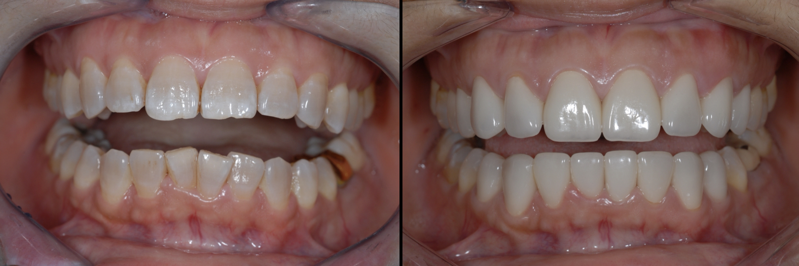 Before and After Image: Veneers -