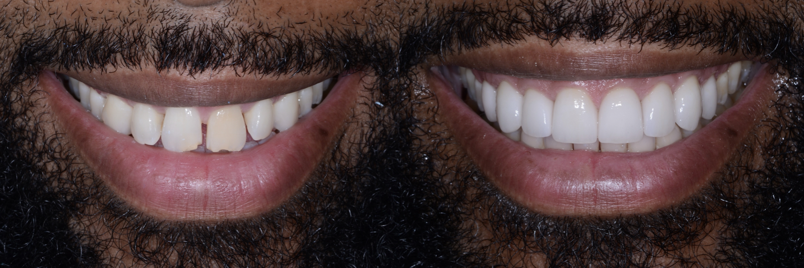 Before and After Image: Veneers - front