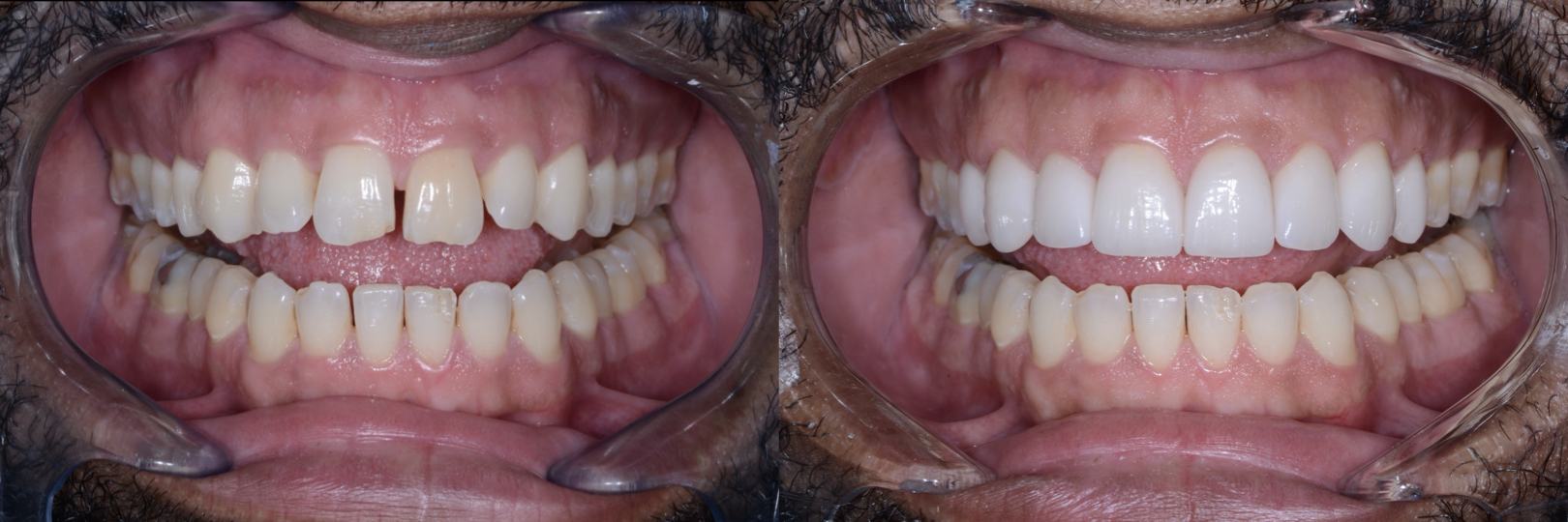 Before and After Image: Veneers - front