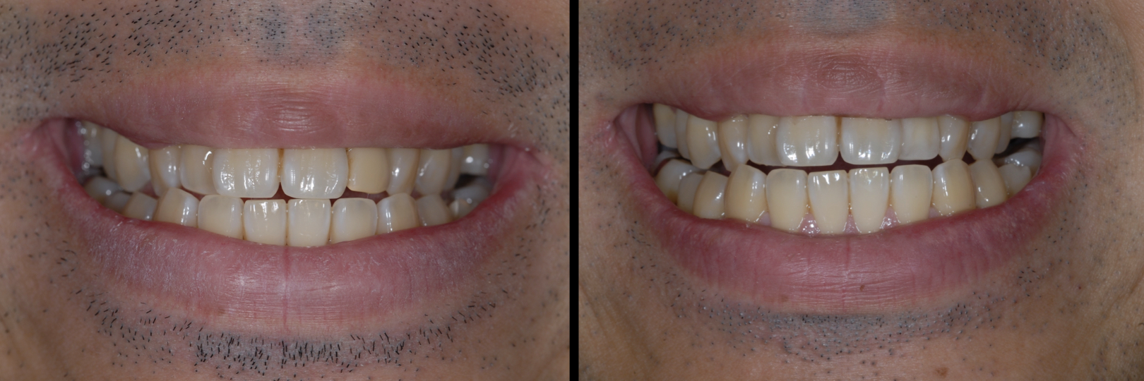 Before and After Image: Zirconia Crown