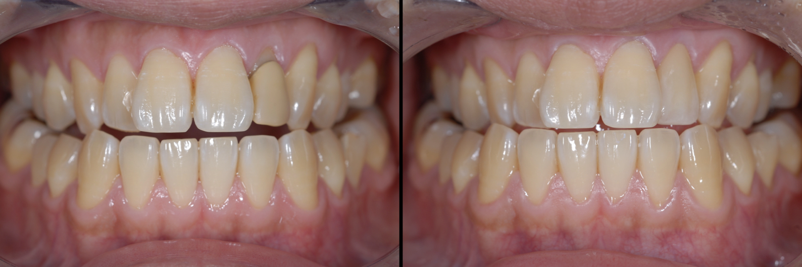 Before and After Image: Zirconia Crown - front