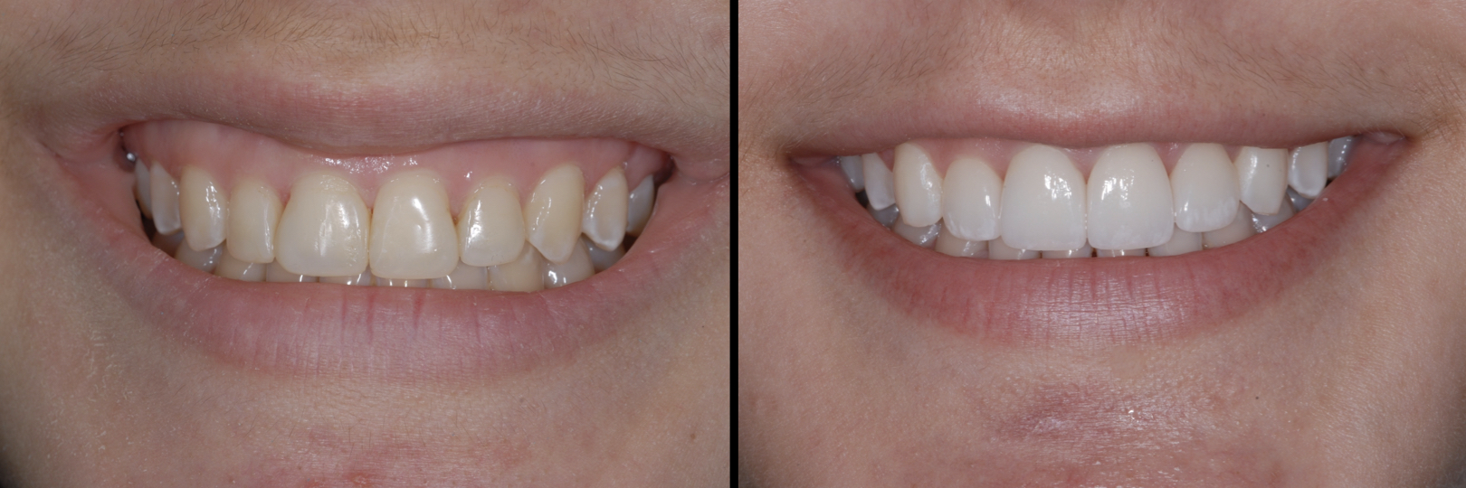 Before and After Image: Feldspathic Veneers - front