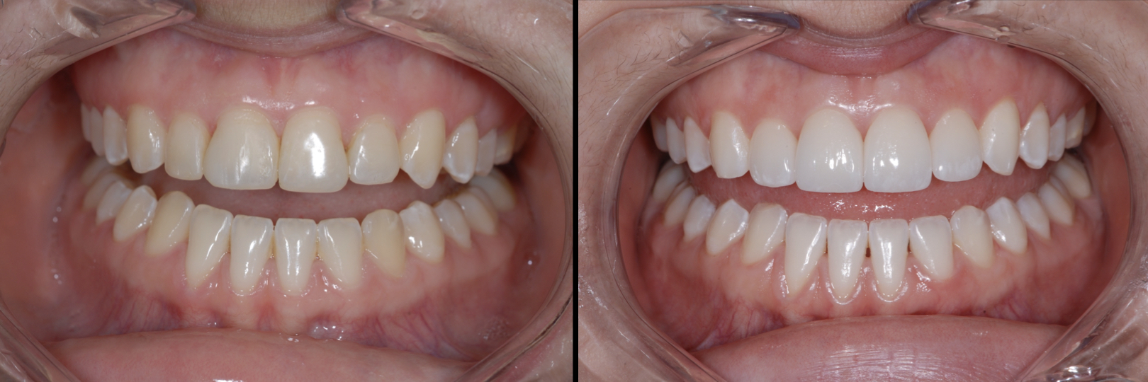 Before and After Image: Feldspathic Veneers - front