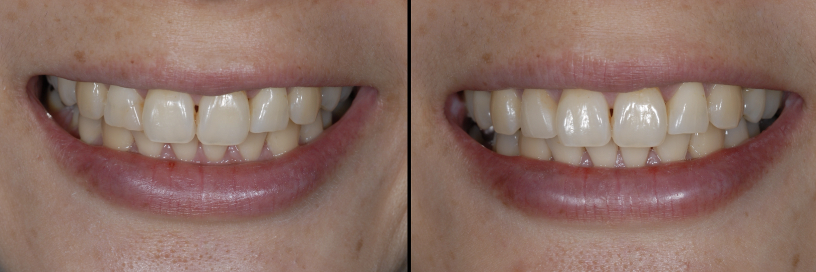 Before and After Image: Feldspathic Veneers - front