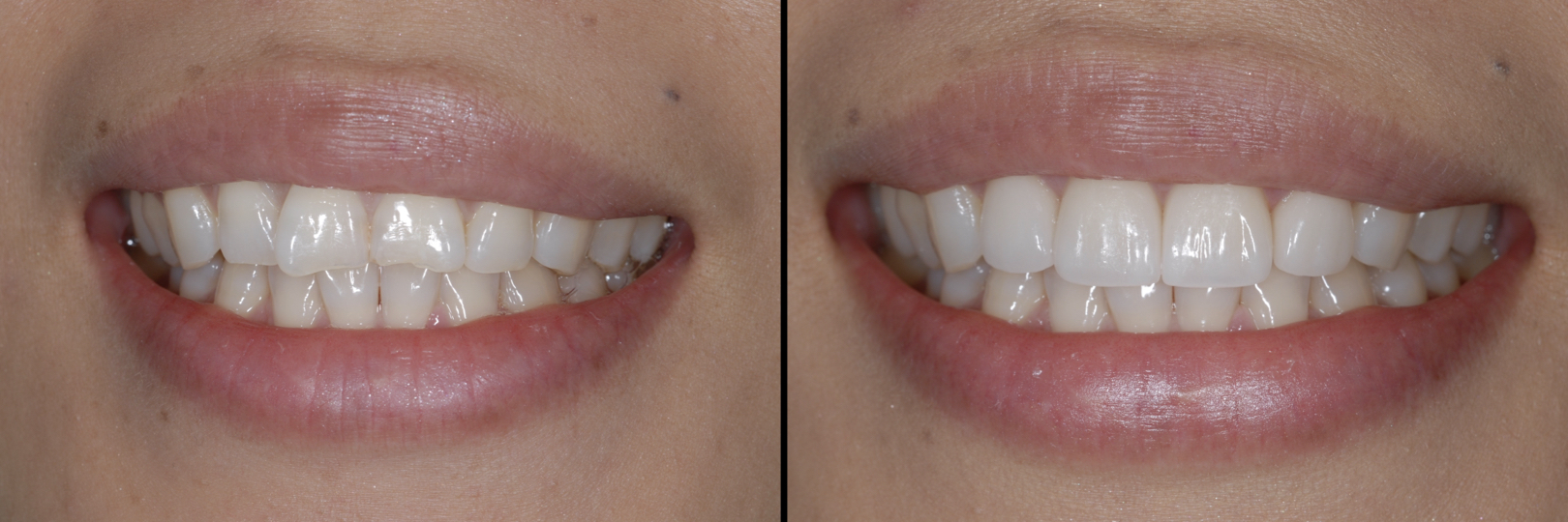Before and After Image: Feldspathic Veneers - front