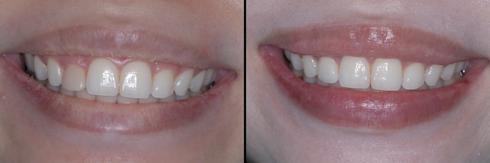 Before and After Image: Emax Crown