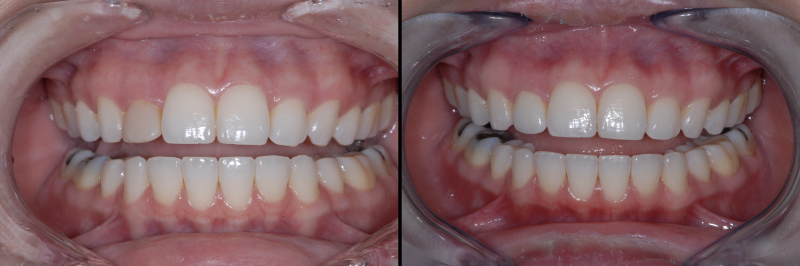 Before and After Image: Emax Crown - front