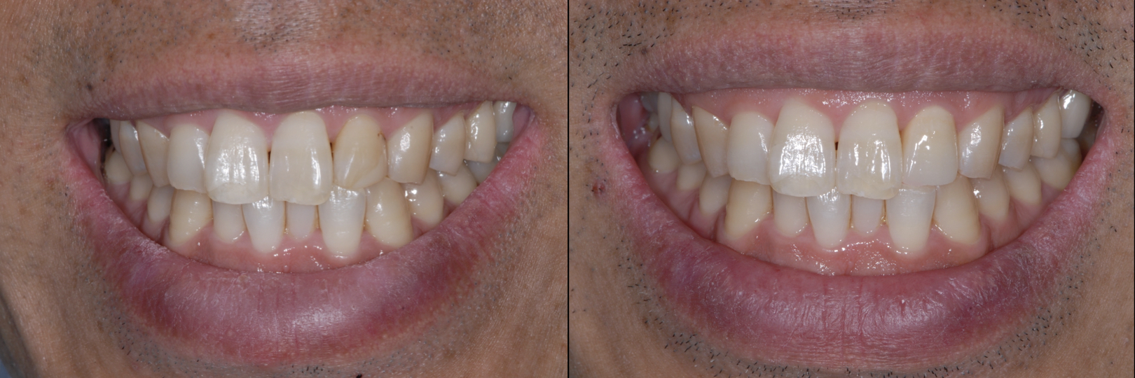 Before and After Image: Zirconia Crown