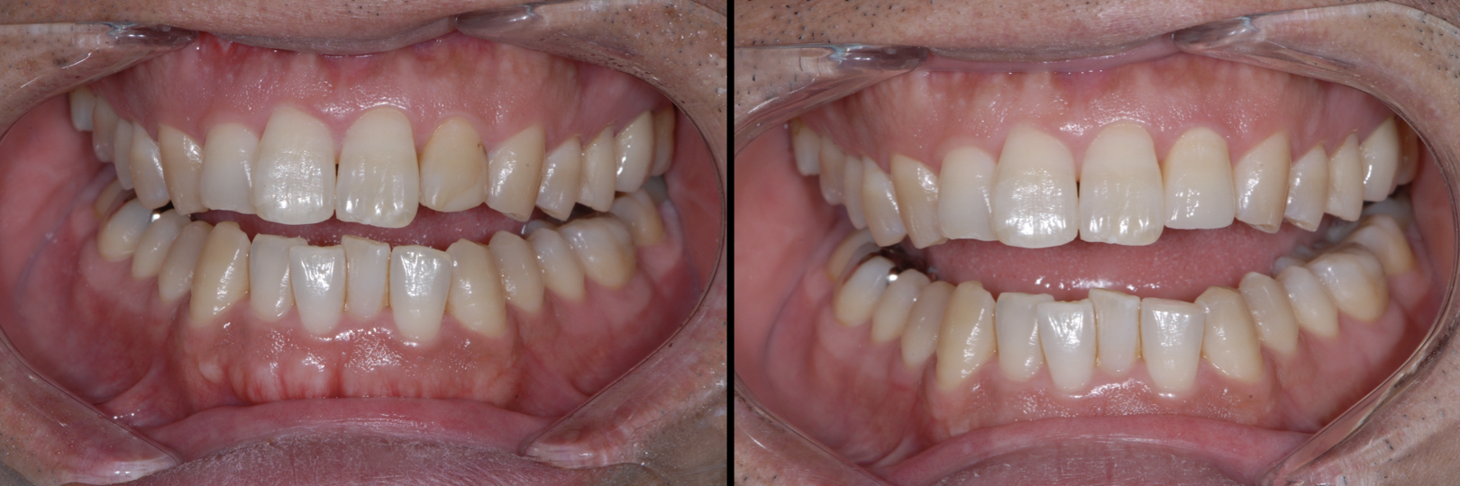 Before and After Image: Zirconia Crown - front