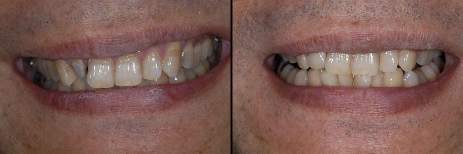 Before and After Image: Emax Crown