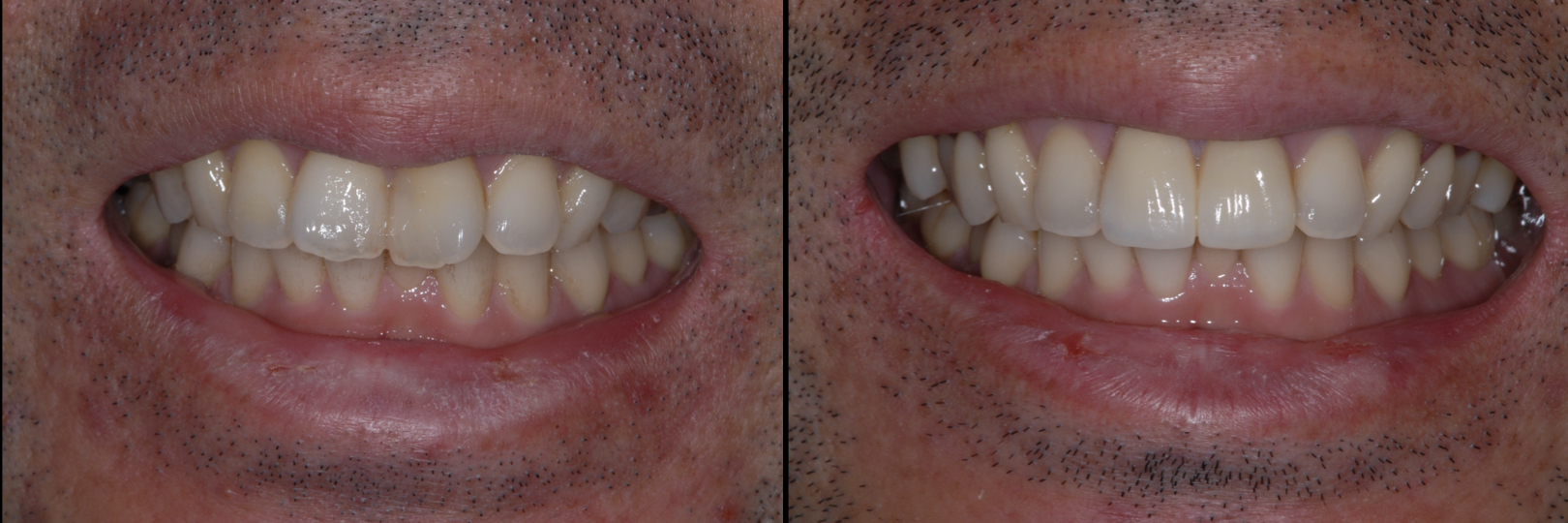 Before and After Image: Zirconia Crowns - front