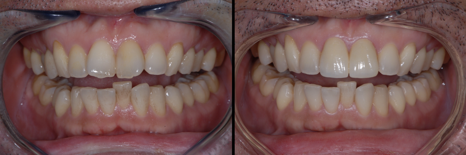 Before and After Image: Zirconia Crowns - front