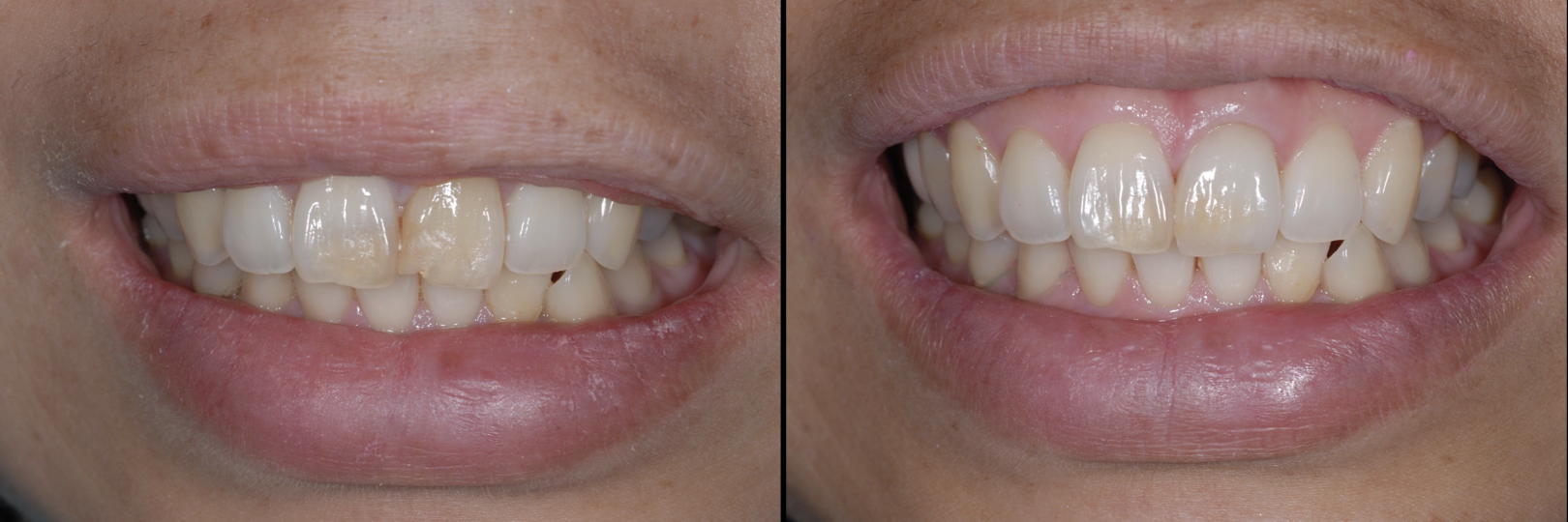 Before and After Image: Feldspathic Veneers - front