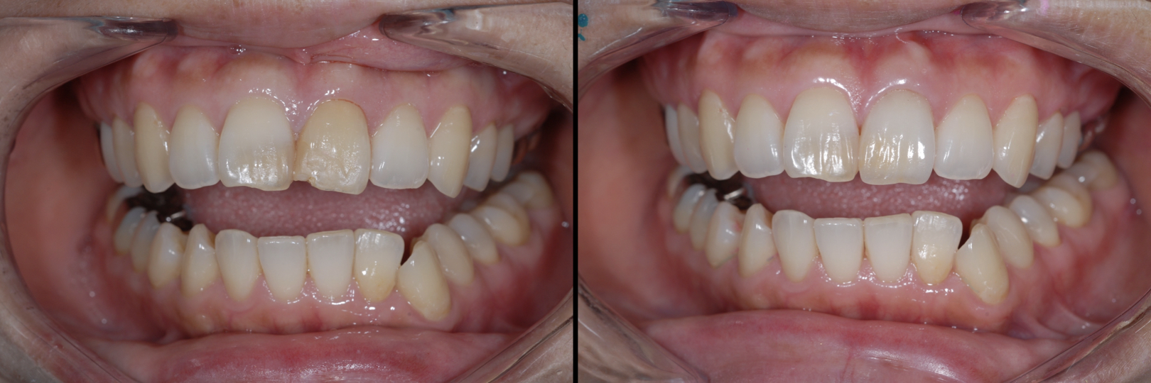 Before and After Image: Feldspathic Veneers - front