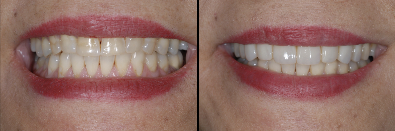 Before and After Image: Direct Composite Veneers - front