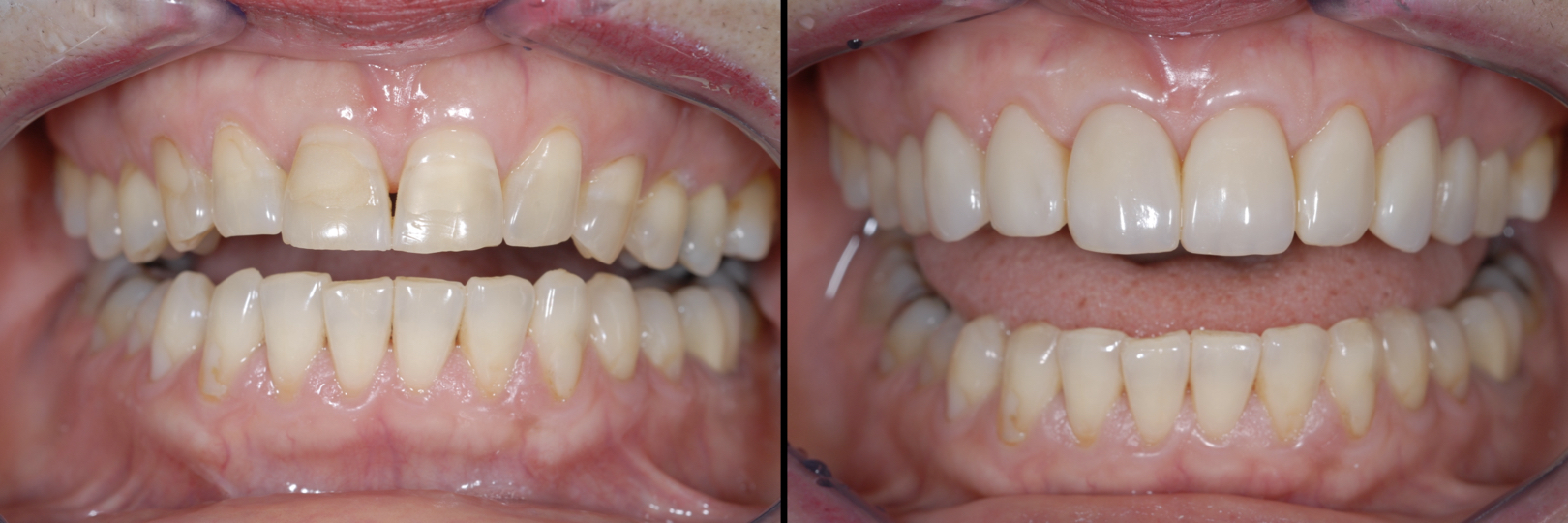 Before and After Image: Direct Composite Veneers - front