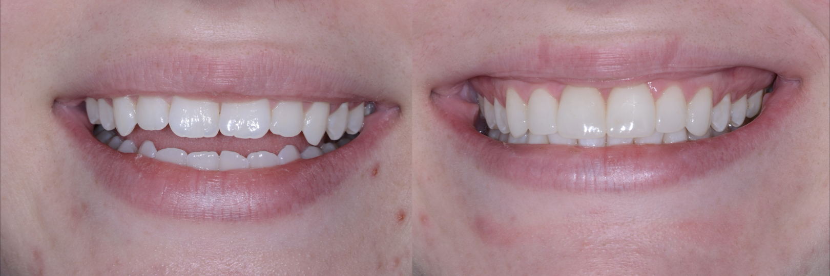Before and After Image: Direct Composite Veneers - front