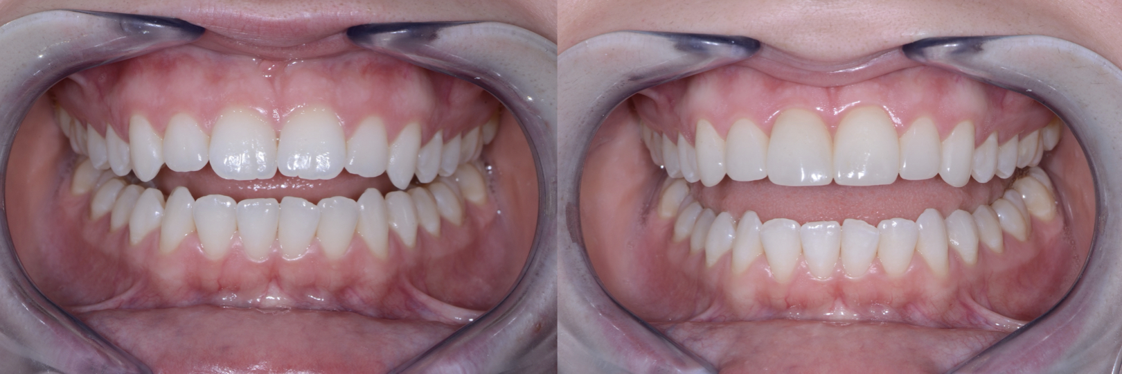 Before and After Image: Direct Composite Veneers - front