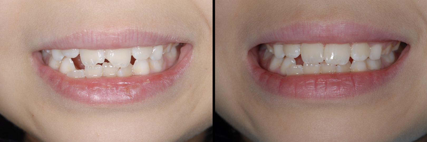 Before and After Image: Composite Bonding - front