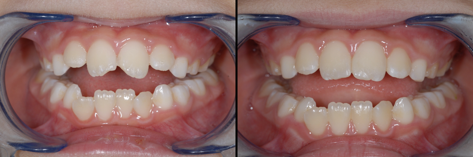 Before and After Image: Composite Bonding - front