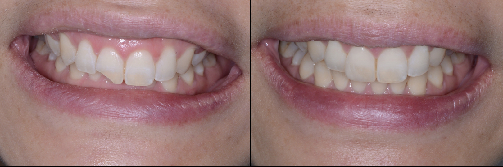 Before and After Image: Composite Bonding - front