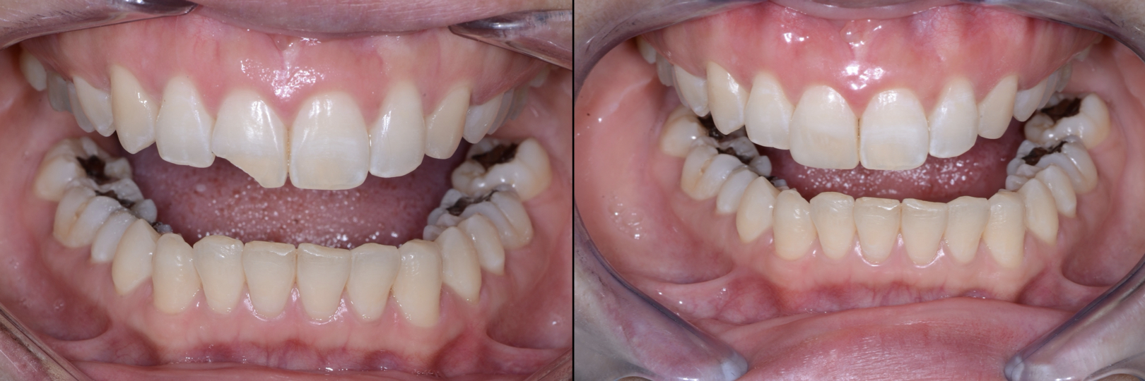 Before and After Image: Composite Bonding - front