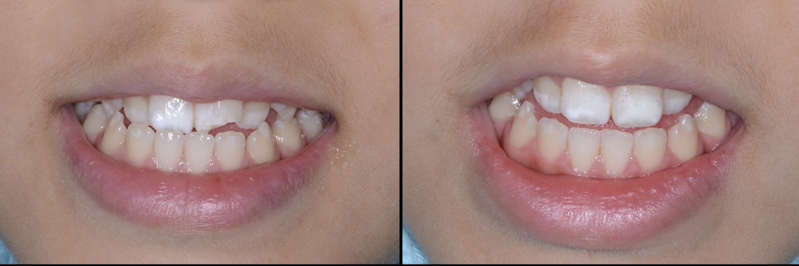 Before and After Image: Composite Bonding - front
